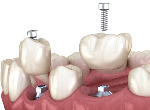 2026年口腔种植牙价格表：你需要知道的费用和选择！