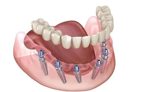 种植牙需要多长时间完成全过程啊? 详解3个关键步骤！