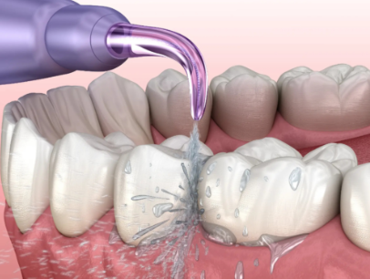影响洗牙时间的因素：牙结石情况