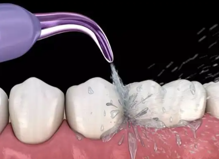 洗牙后的护理与时间关联