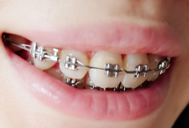 不同年龄段牙齿矫正的费用差异