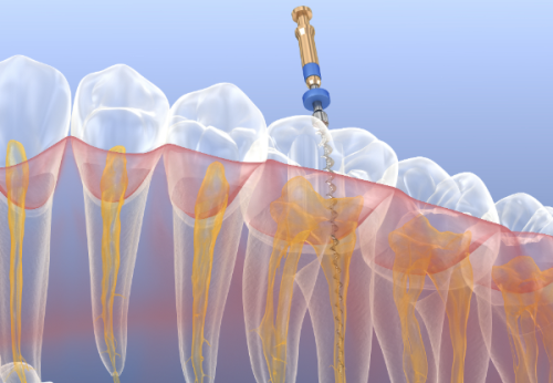 根管治疗的麻醉方式及成效