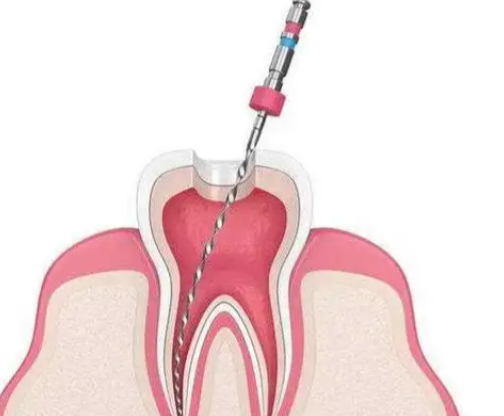 根管治疗后的长期护理
