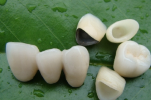 烤瓷牙的不足之处