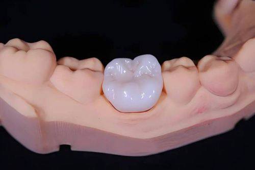 物价差异对全瓷牙冠价格的影响