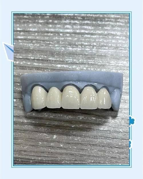 烤瓷牙做核磁共振有什么影响？解答你最关心的问题！