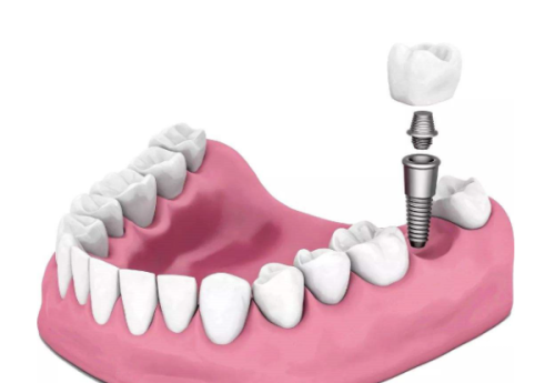 种牙打钉子后修复期注意事项