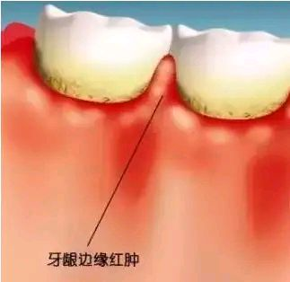 缓解牙齿治疗后疼痛的小贴士