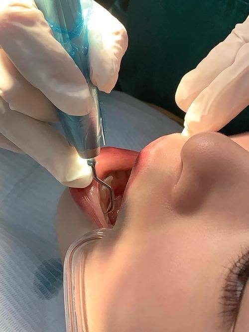 牙齿美容整形多少钱？2026年最新价格揭秘与注意事项！