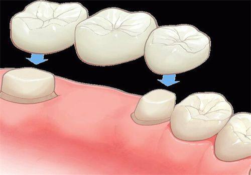 不同人群种植牙使用寿命差异