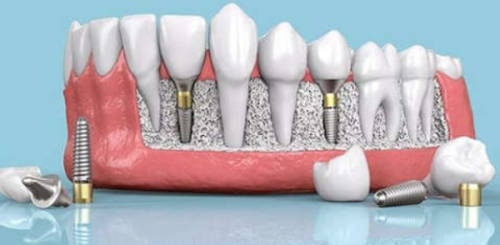 保养技巧延长种植牙寿命