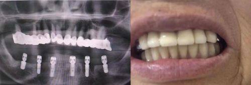 3个月后安装牙冠的情况