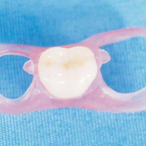 推荐材料一：纯钛金属基托活动义齿