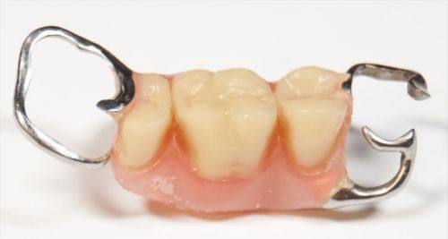 活动义齿佩戴后的注意事项