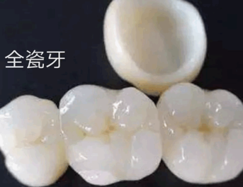 全瓷牙能磨短吗？先了解全瓷牙