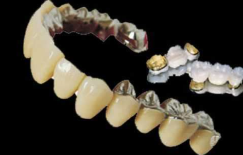 如何延长烤瓷牙的使用寿命