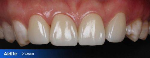 烤瓷牙做核磁共振有什么影响？解答你必须知道的5个要点！