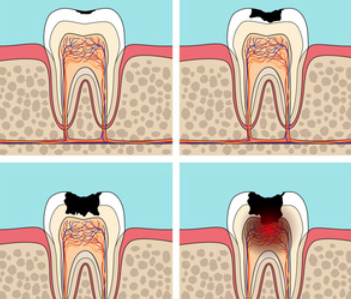 手术治疗之拔牙种植