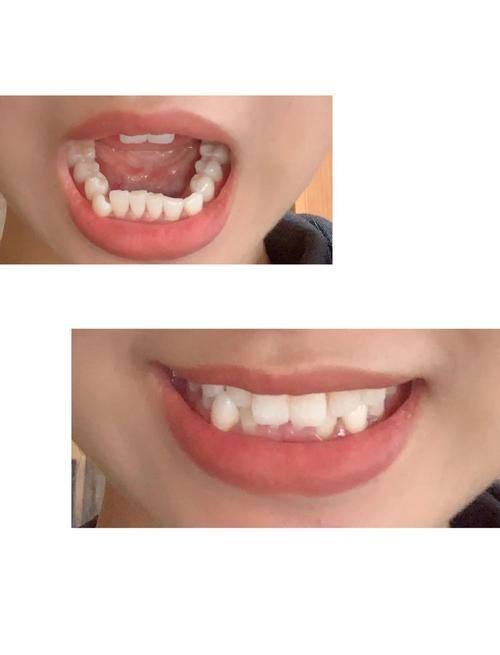 选择烤瓷牙贴面的实用建议