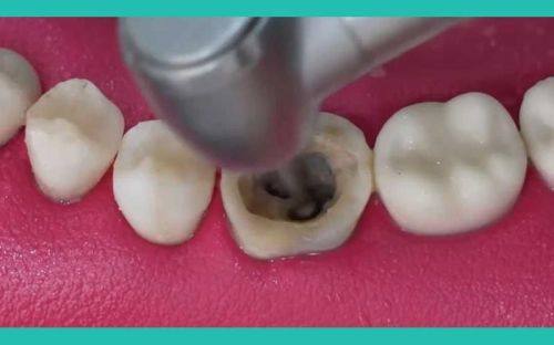 影响根管治疗疼痛的因素