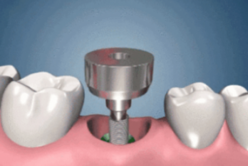 保护种植牙良好成效的术后注意事项
