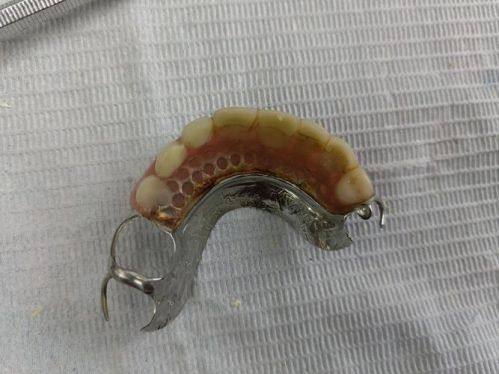 弹性义齿树脂：美观与舒适的结合