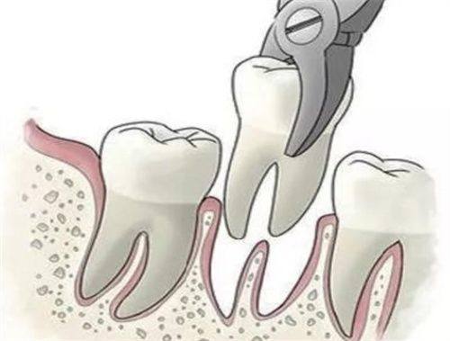 上午拔牙的适合人群