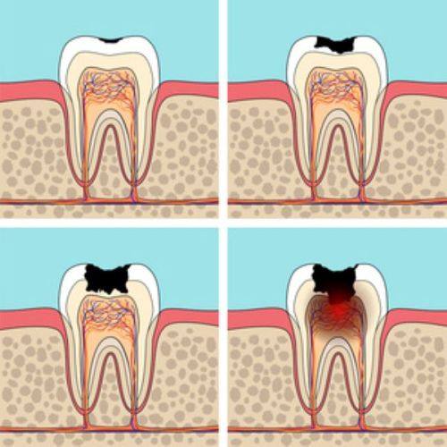未累及牙髓的蛀牙处理方法