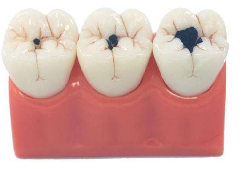 非手术治疗之窝沟封闭