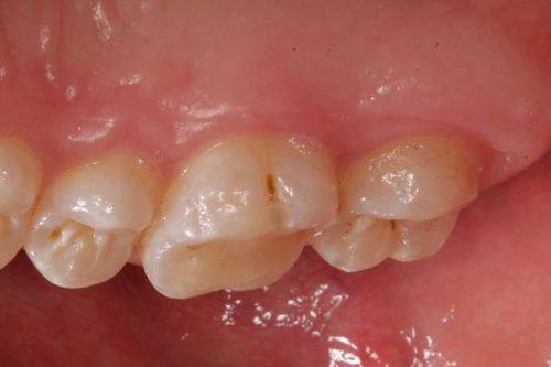 加强口腔清洁，从细节做起