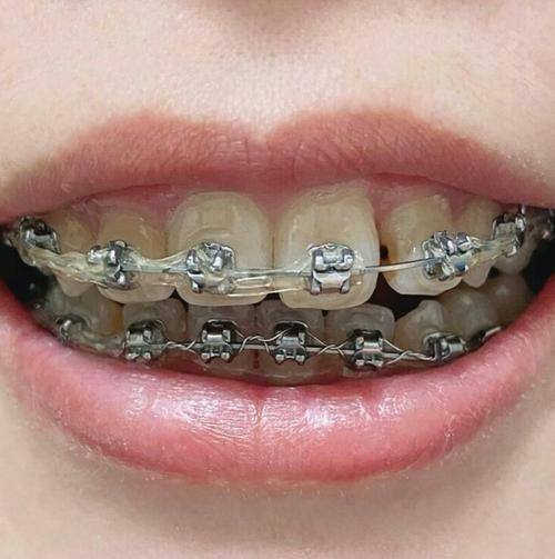 拆钢丝后保持器的佩戴时长