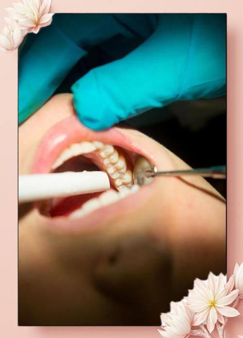 拔牙有规定上午下午拔吗？揭秘最佳拔牙时间！