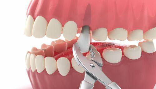 拔牙后疼痛会持续多久？揭秘恢复期的真实体验与建议！