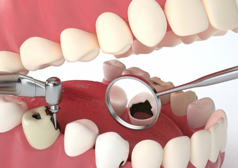 含氟牙膏，助力牙齿再矿化