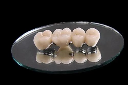 影响烤瓷牙套寿命的因素