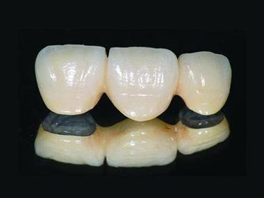 烤瓷牙套寿命一般几年？了解这些让你更安心！