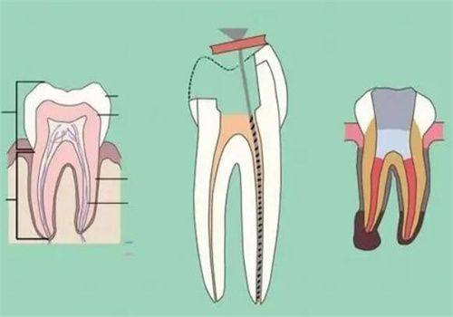 根管治疗的牙齿一般可以管多少年？揭秘持久效果与护理技巧！