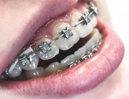 恒牙期(12 - 18岁):全方面矫正至佳时期