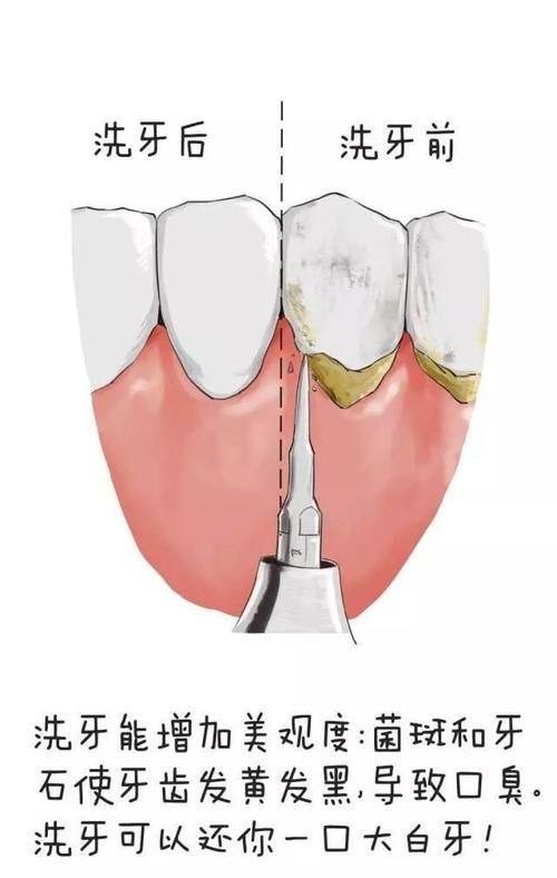 不适合洗牙的人群