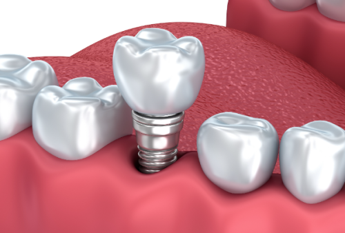 常规种植牙的时间安排