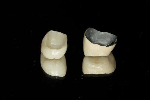 不同材料烤瓷牙价格排序