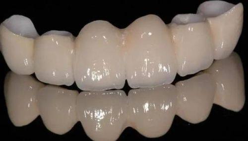 2026年烤瓷牙价格揭秘：你不可不知的费用与选择！