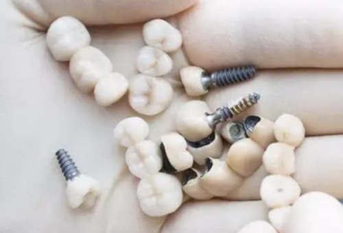 后期修复：基台安装与牙冠修复