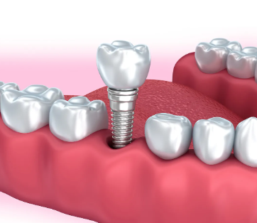 延长国产种植牙寿命的护理技巧