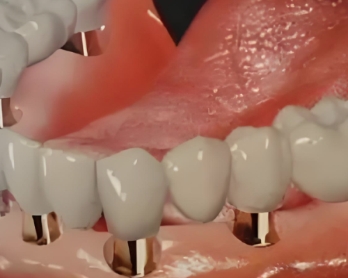 种植体材料对寿命的影响