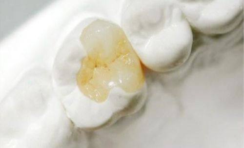 填充材料与补牙费用的关系