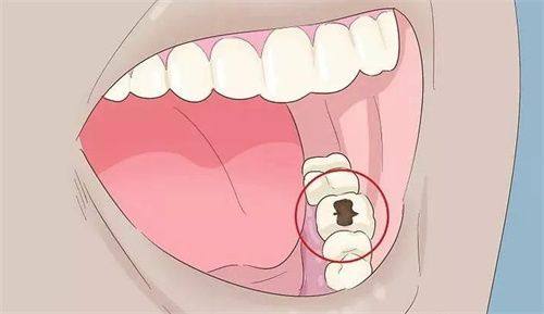 如何选择合适的补牙方案