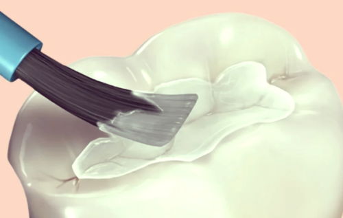 玻璃离子类材料的特点