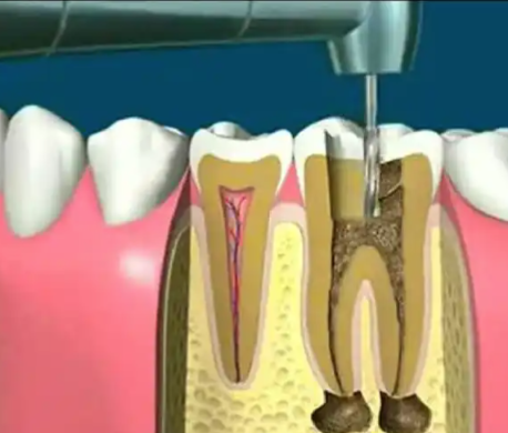 第四步：根管充填