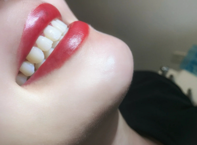 牙齿美白后注意事项：5个关键点让你的微笑更自信！